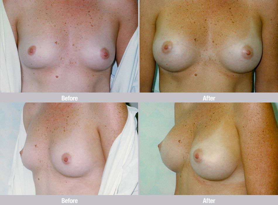 34b Breast Nude