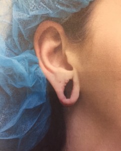 Before Earlobe Surgery