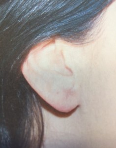 After Earlobe Surgery